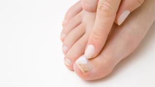 ما هي أسباب تقصف أظافر القدم؟ اكتشف العوامل البسيطة والخطيرة المؤثرة على صحتها