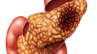 ما هي الأعراض التي لا يجب تجاهلها؟ طبيب متخصص يكشف “الشكل الأكثر رعبا” من السرطان