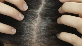 هل تساعد شوكة الطعام في التخلص من الشيب؟ إليك الحقيقة والعلاجات المنزلية الممكنة