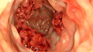 سرطان القولون : كيف تزيد الأطعمة فائقة المعالجة خطر الإصابه به؟ دراسة تكشف العلاقة وتأثير الالتهابات