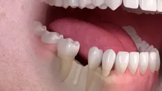 علاج فقدان الأسنان : هل يمكن للأسنان أن تنمو مجددا بشكل طبيعي؟ عقار ياباني ثوري يعيد الأمل